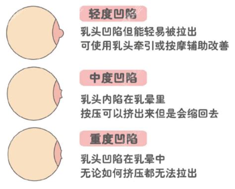 奶頭上長毛|乳頭內凹、長毛正常嗎？ 8類「乳頭形狀」你的是哪種